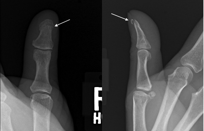 Small thumb distal phalanx tuft fracture (arrow)