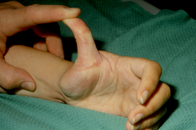 Volar plate rupture left thumb MP joint during volar plate stress testing