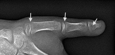 Normal Pediatric Thumb. Note open growth plates at arrows.