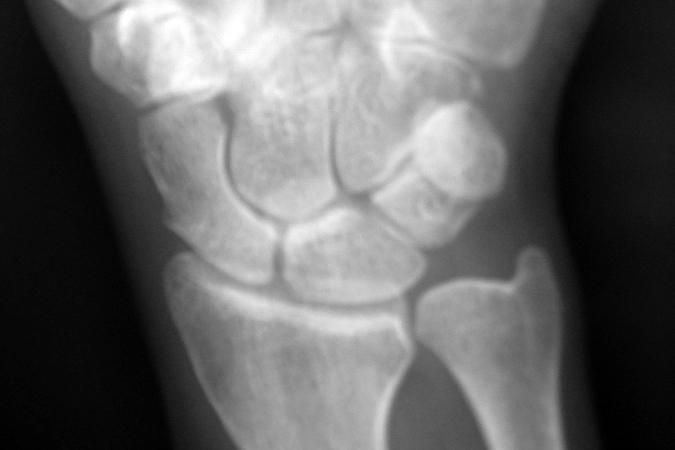 Significant ulnar positive variance right wrist in a gymnast