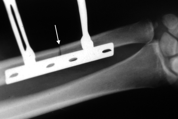 Compression plate held in place with bone clamps prior to screw fixation and osteotomy compression.  Arrow at osteotomy site.