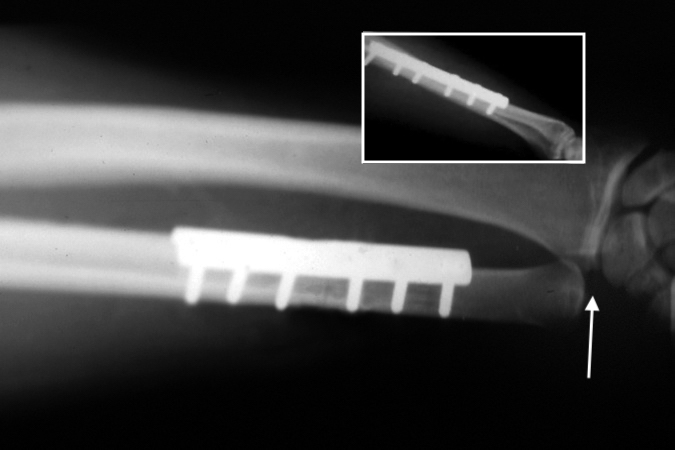Postoperative AP & Lateral X-rays after shortening and internal fixation. Note 1mm of negative ulnar variance (arrow) after shortening osteoplasty.