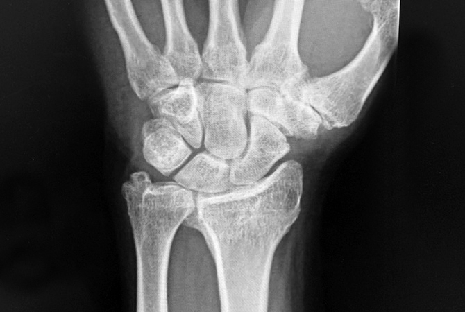 Marked positive ulnar variance with degenerative changes in the ulnocarpal joint but no symptomatic OA in DRUJ.