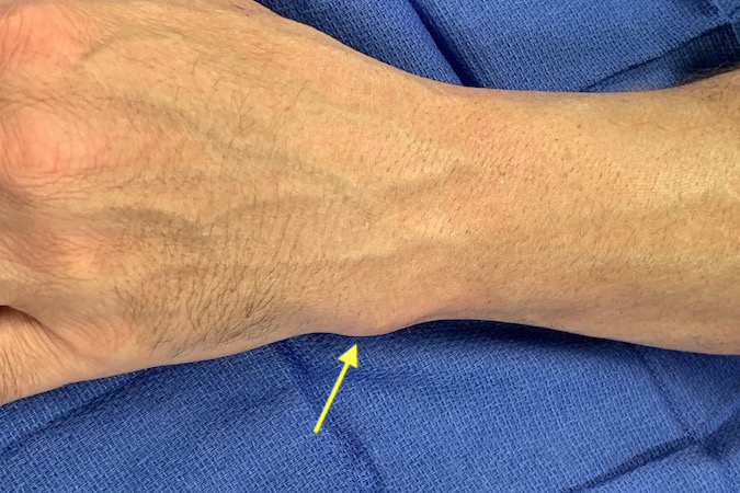 Left wrist of a 48 y.o. right handed male with severe ulnar impaction syndrome. Note mild prominence of distal ulna (arrow).  Patient also had marked tenderness in this area.