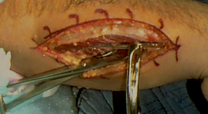 Standard AO plate being placed on ulnar to check positioning.