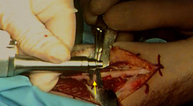 Second cut being made. Note extra blade (guide for plate of second cut)  being held in the first cut by a hemostat.  Arrow on piece of bone to be removed.  Saw removes 1mm of bone. Piece 2mm wide so two cuts and removed bone will shorten ulna 4mm.