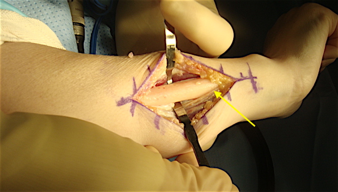 Right ulnar shaft exposed for ulnar shortening.  Keep periosteal (arrow) stripping to a minimum to maintain blood supply to the bone.