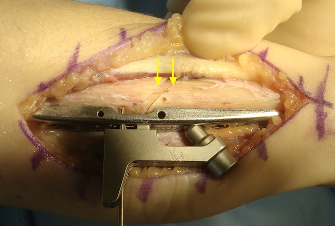 Both osteotomy cuts have been completed (see arrows).