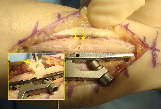 Both oblique parallel osteotomies (double arrows) has been completed.  Insert shows bone being removed (single arrow).