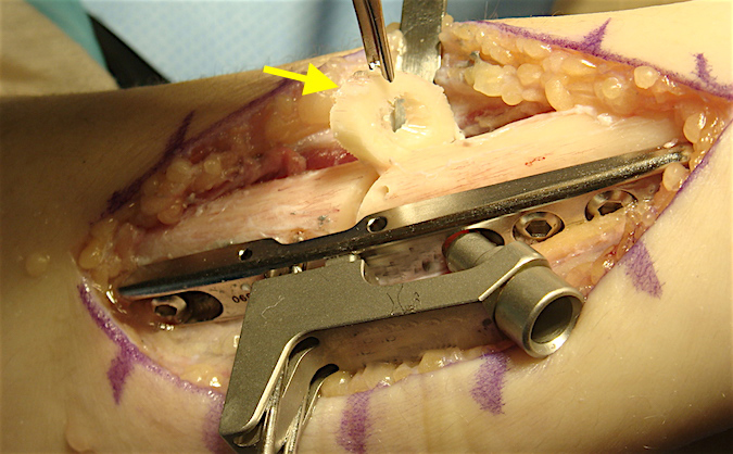 Bone fragment being removed to allow shortening (arrow).