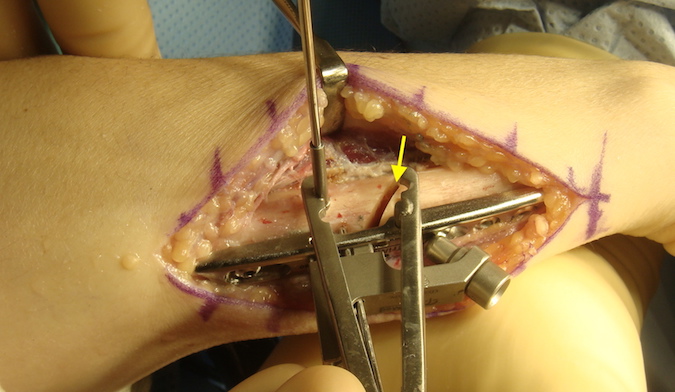Defect in ulna (arrow) shown prior to compression.  The compression clamp is attached to the plate and to an extra temporary K-wire.