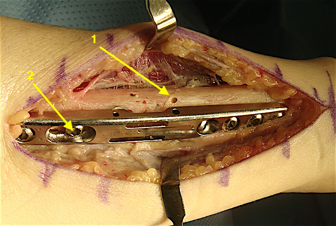 Osteotomy (1) tightly compressed.  Note the screw in the slotted hole has moved proximally towards the osteotomy as the osteotomy was closed.