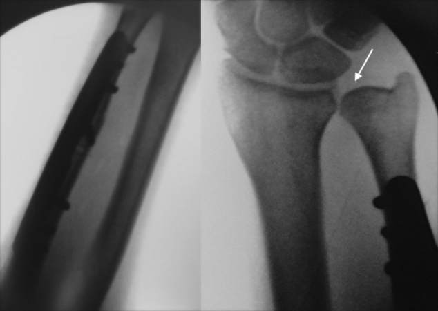 Completed ulnar shortening osteoplasty.  Note the neutral variance (arrow).