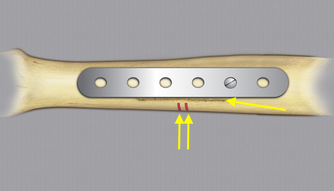 The set up for a standard ulnar shortening osteotomy using a AO plate and screws. Note the guide lines for a 4mm shortening (double arrow) and the etched line used to assess rotation after cutting the ulna (single arrow). One temporary screw in place.