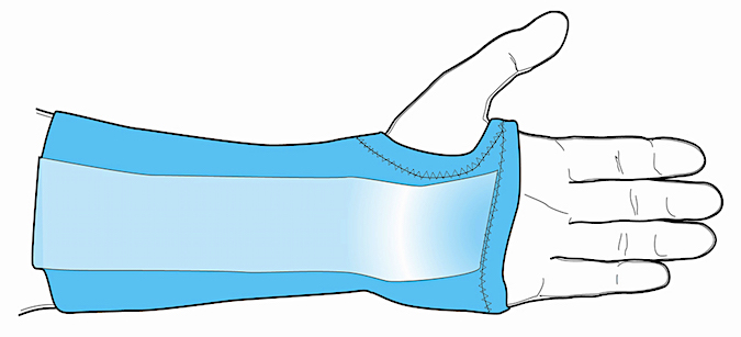 Wrist brace treatment for an non-acute pisiform fracture without displacement
