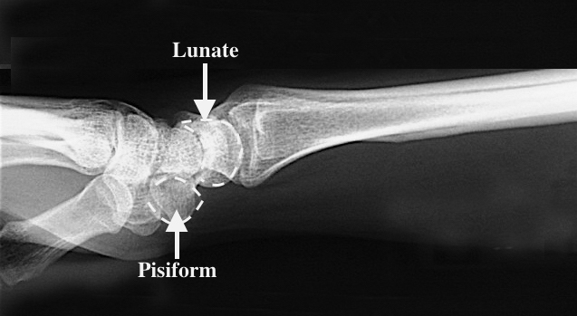 The lateral X-ray shows the pressure points used during the L-T ballotment.