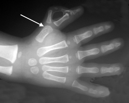 Bifid Thumb Right ( Wassel IV). Note wide metacarpal head (arrow).