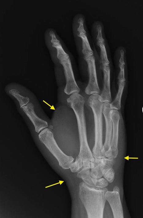 Cellulitis secondary to cat bite. Note soft tissue swelling (arrows). Bones are normal.